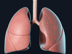 Dampak Merokok pada Penyakit Paru Obstruktif Kronis (PPOK)
